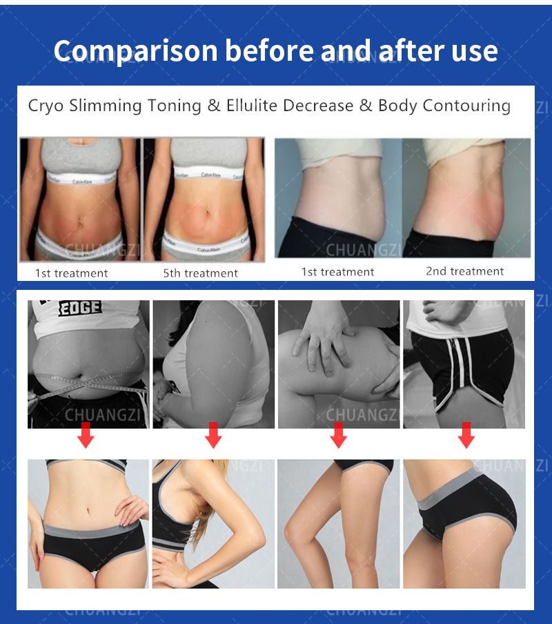 Significant slimming and toning results achieved through cryotherapy treatments, reducing cellulite and improving body contour.