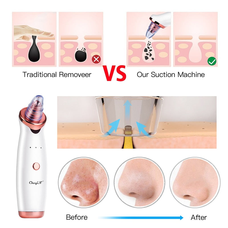 Traditional Remover VS Our Suction Machine ChcyiN