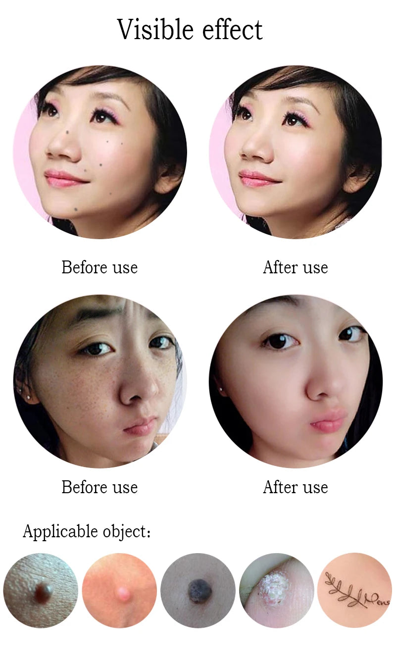 Transform mole skin tags with before-and-after results, ideal for [XXKoos] beauty care tool.