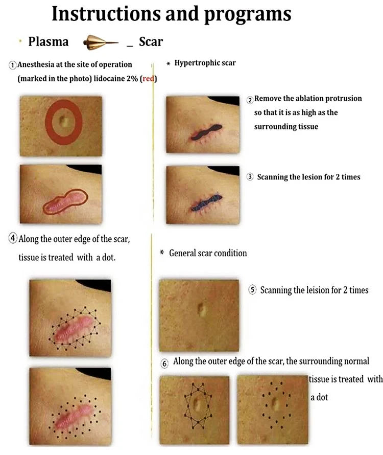 Use lidocaine anesthesia and remove protrusions at ablation site; treat hypertrophic scars with targeted dots.