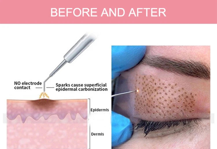 Non-invasive plasma pen removes freckles, moles, and acne scars without damaging skin.