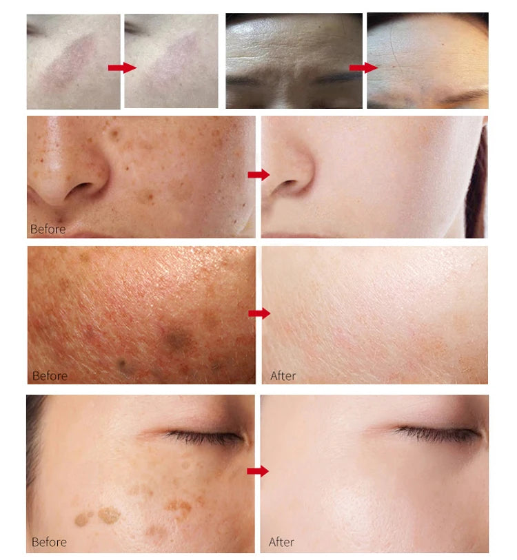 See dramatic results with our cold plasma pen for skin tightening and scar removal.