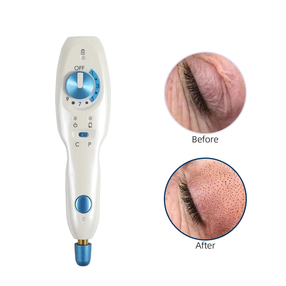 Plasma pen for skin tightening, acne removal, and mole treatment.