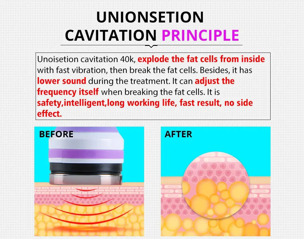 Cavitation ultrasonic machine breaks down fat cells using radio frequency and vacuum technology.