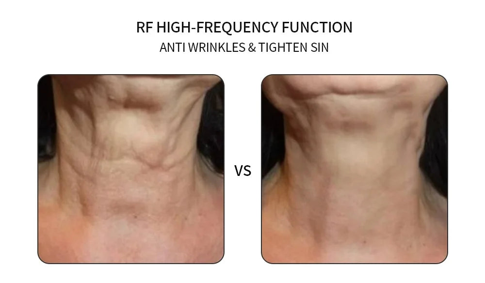 RF treatment reduces wrinkles and tightens skin for a youthful appearance.