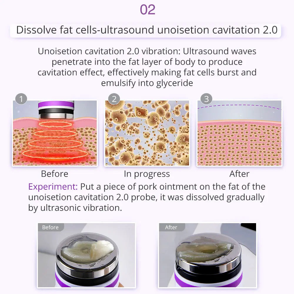 Ultrasound waves dissolve fat cells, breaking them down into glyceride.