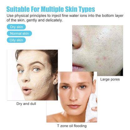 Suitable For Multiple Skin Types Use physical principles to inject fine water