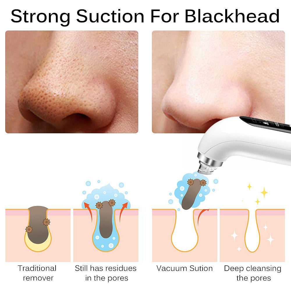 Strong Suction For Blackhead Traditional Still has residues Vacuum