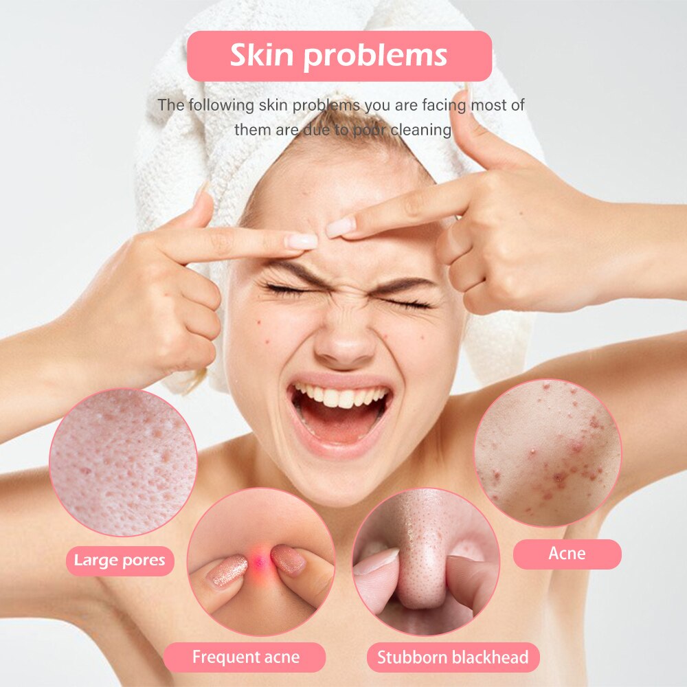 the following skin problems are due to popr cleaning Acne Large