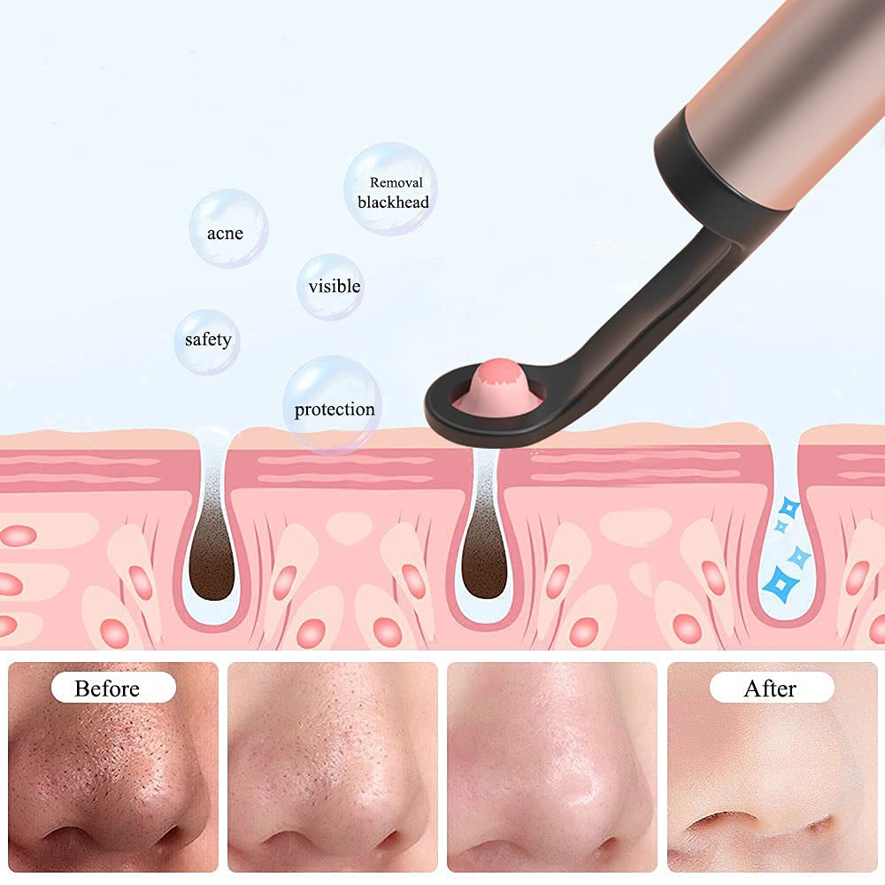 Removal blackhead acne visible protection Before After