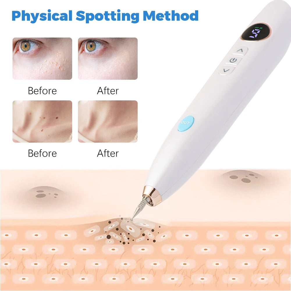 Effortless mole and wart removal using a before-and-after physical spot remover with USB charging.