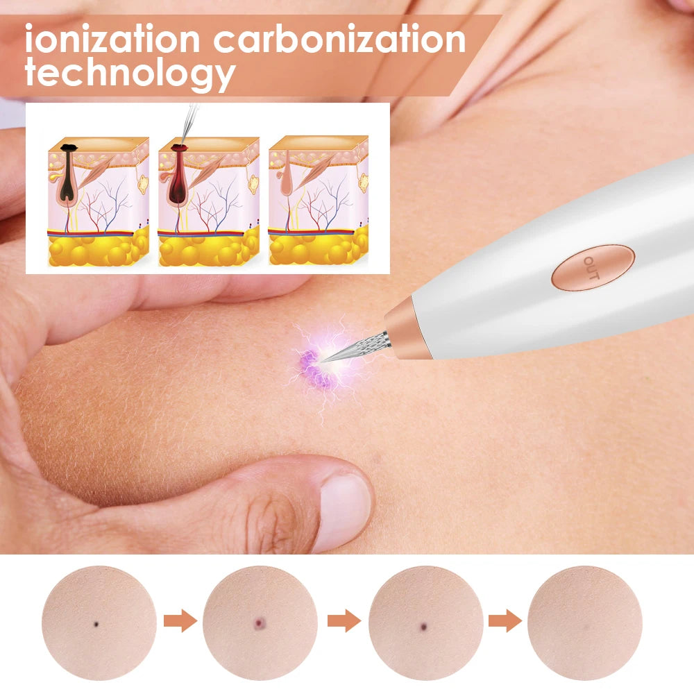 Advanced blue light technology for mole removal