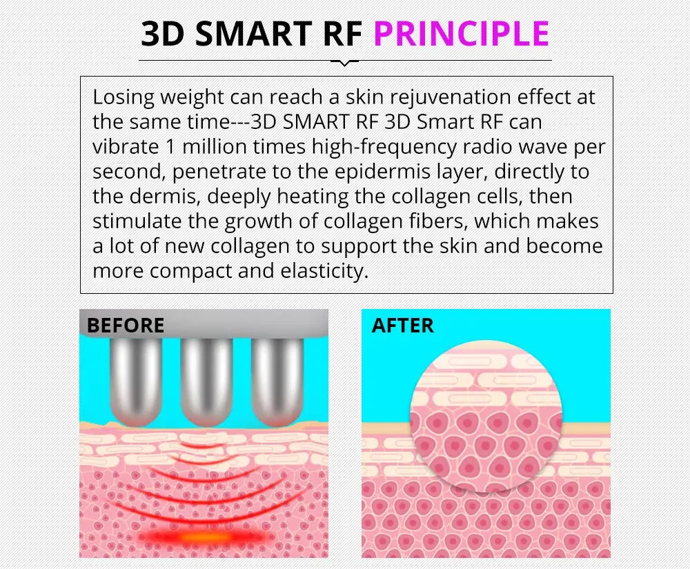 Non-invasive 3D SMART RF technology stimulates collagen growth for toning and youthful appearance.