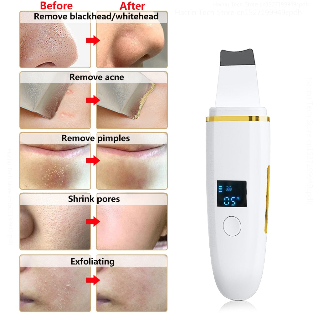 Eliminador de depurador de piel ultrasónico Espinilla Peeling ultrasónico Limpiador facial Pala Limpieza profunda Estiramiento facial Eliminar acné de poros