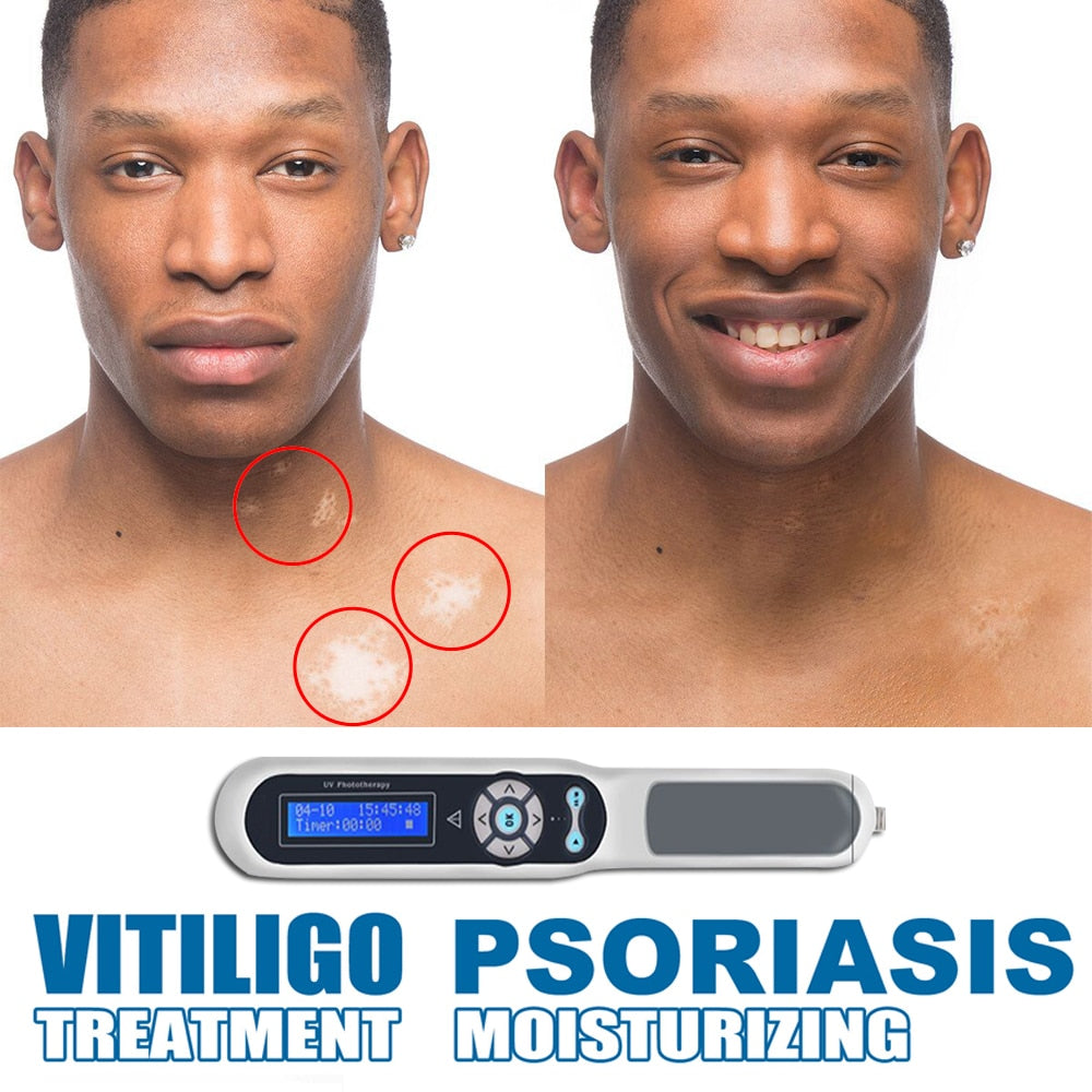 VitILIGO PSORIASIS URQUM MOI